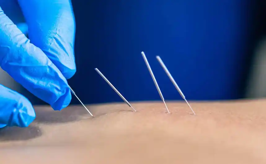 Pratique du Dry Needling en physiothérapie : formation, sécurité et bonnes pratiques